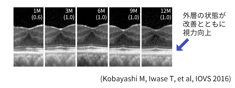 網膜硝子体疾患に対するOCT（光干渉断層計）を用いた研究